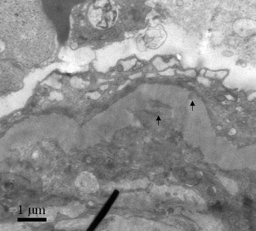Figure 4. Subendothelial and subepithelial electron-dense deposits were seen by electron microscopy (arrowheads).