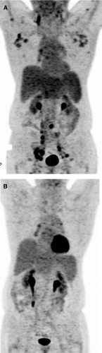 Figure 1.  A. Initial 18F-fluorodeoxyglucose (FDG) positron emission tomography (PET) reveals mild FDG activity in bilateral jugulodigastric (standardized uptake value [SUV] of 3.5) and axillary lymph nodes (SUV of 2.7) with additional uptake noted in the right supraclavicular, right hilar, subcarinal, portocaval, mesenteric, retroperitoneal, iliac (SUV of 13.8), and inguinal lymph nodes. There is an enlargement of the spleen with increased activity (SUV of 7.1) as well. B. Compared to the examination obtained at diagnosis, the repeat PET scan obtained a year later shows complete remission of the disease, with no enlarged FDG-avid nodes in the neck, chest, abdomen, or the pelvis.