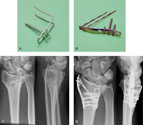 Figure 1. A. Dorsal buttress pin with washer and bicortical screw. B. Radial pin plate with pins and screws. C. Preoperative radiograph. D. The fixation device and the bone substitute in place.