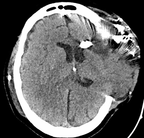Figure 9 Axial view of the head CT showing VP shunt placement, right to left cerebral midline shift, and external brain herniation.