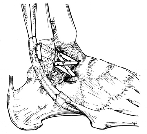 Figure 3. The plantaris tendon is pulled through the drill holes, once or twice in a figure-of-eight and once in a circular configuration. To stimulate the vascularization of the free transplant, the remaining anterolateral ligaments and capsule are integrated into the reconstruction.