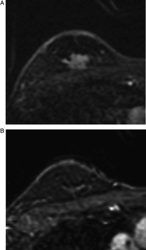 Figure 1.  MRI before (A) and after (B) chemotherapy in a case accurately predicting residual disease. The tumor mass, measuring 1.7×2.0 cm before chemotherapy (A), disappeared completely on MRI after chemotherapy (B).