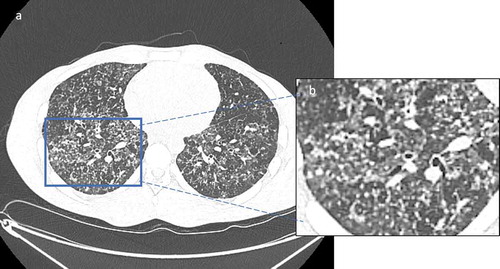 Figure 6. Chest computerized tomography scan displaying diffuse bilateral micronodules in a branching pattern (“tree-in bud pattern”) in a patient with non-tubercular mycobacterial infection. Figure A represent the cross-section of the CT scan and Figure B represent the magnified view of the selected section of CT image.