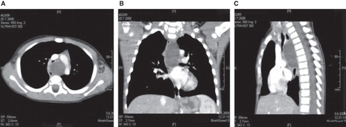 Figure 2. Contrast-enhanced computed tomography (CECT) of the thorax with multiplanar reconstructions. A: axial scan;B: coronal scan;C: sagittal scan.