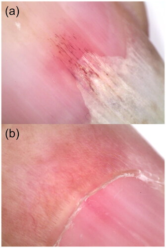 Figure 3. Characteristics of dermoscopic examination. (a) Subungual splinter hemorrhages. (b) Telangiectasia at the area of nail folds.