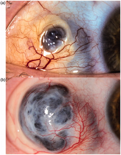 FIGURE 1. Scleromalacia located in the upper area of the temporal bulbar quadrant. (a). Note the loss of scleral tissue centrally and a change of transparency in the adjacent tissue, visible as a bluish discoloration. (b). The same eye is shown 8 years later with marked progression of the scleromalacia and a bulging staphyloma.