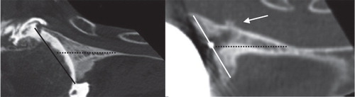 Figure 5. Preoperative axial view of the posteriorly eroded glenoid (left) and postoperative axial view of the same specimen with an implant (right). The orientation of the glenoid vault is indicated by the dotted line. The orientation of the eroded glenoid is indicated by the black line on the left part of the figure. The orientation of the glenoid implant is indicated by the white line on the right part part of the figure. The white arrow indicates anterior perforation of the glenoid vault due to the retroverted orientation of the implant in this preoperatively eroded glenoid.