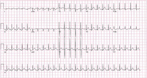 Figure 3. EKG on discharge. (HR 151, QRS 48).