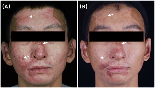 Figure 3. A 26-year-old burn male with hypertrophic scars on face at (A) baseline and (B) 3 months after three CO2-IPL treatments showing great improvement in vascularization, pliability and thickness.