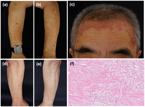 Figure 1. (a–c) Clinical presentation before treatment. Yellow-red papules and plaques on the forearms and on the forehead. (d,e) A clinical picture on the forearms after 2 weeks of treatment. (f) Histological analysis from the left forearm with hematoxylin and eosin staining (×200) showed palisade-like granulomas in the dermis, accompanied by eosinophil infiltration.