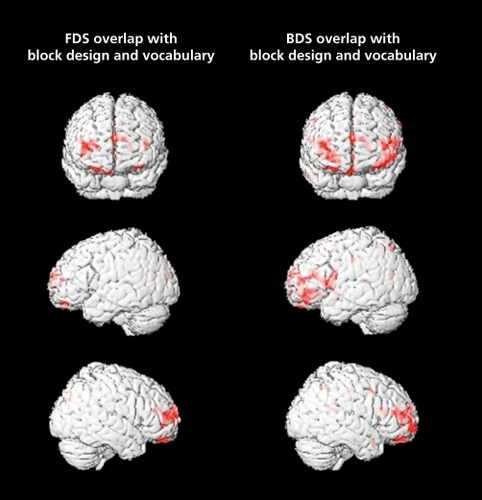 Figure 5. Overlap of correlations between gray matter and g (conjunction of block design and vocabulary) and gray matter and forward (FDS) and backward (BDS) digit span scores (P<01).Citation39