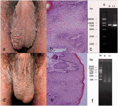 Figure 2. Clinical and histologic appearance of scrotal lesions in a 35-year-old man with warts and Darier disease. (a) Papillary and cauliflower-shaped papules and plaques in the scrotum. (b) Patches of vacuolated keratinocytes in thickened epidermis were characteristic of HPV-infected skin (hematoxylin-eosin, original magnification ×200). (c) DNA segments specific for HPV types 6 and 11. (d, e) Clinical and histologic findings after 2 months hyperthermia treatment, showing resolution of the warty lesions. (f) No HPV-specific DNA was detected after 2 months treatment.