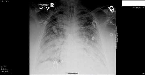 Fig. 2.  Follow up chest radiograph on patient 1 eight hours after presentation.