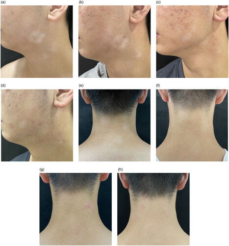 Figure 1. Clinical pictures of rash during treatment. (a) Facial white patch at baseline, with irregular shapes and blurred margins. (b) One month after upadacitinib, the size of the white patch was reduced and repigmentation appeared on the edge. (c) Three months after upadacitinib, further reduction in the size and more repigmentation. His acne worsened at the same time. (d) Four months after upadacitinib, there was nearly 90% repigmentation of his facial white patch. (e) Cervical white patch at baseline. (f) one month after upadacitinib, the color of the white patch reduced. (g)&(h) Three and four months after upadacitinib, the rash showed complete repigmentation.