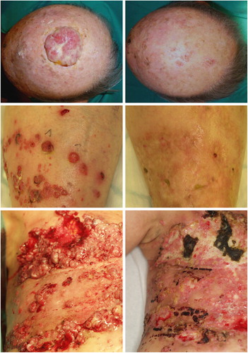 Figure 1. Clinical characteristics of patients. Patients referred for electrochemotherapy present with quite different clinical problems. Top panels: 93-year-old male patient with squamous cell carcinoma of the scalp before treatment (left) and after three treatments (right), treated at University of Rome. Middle panels: 88-year-old female patient with multiple metastases of malignant melanoma on left lower leg, recurrence after several other treatments including surgery and radiotherapy (left side). Four months after one session with electrochemotherapy (right side) all cutaneous and subcutaneous metastases regressed. Typical hyperpigmentation and fibrosis of the skin. Lower panels; 58-year-old female patient with extensive relapse and metastases of breast cancer of the chest wall, accompanied by extensive bleeding and malodour (left side). Eight weeks after first electrochemotherapy session, regression of exophytic tumors, cessation of bleeding and malodur. Development of new metastases at the border of the treated area. Latter two cases treated in Ludwig-Maximilian Institute, Munich.