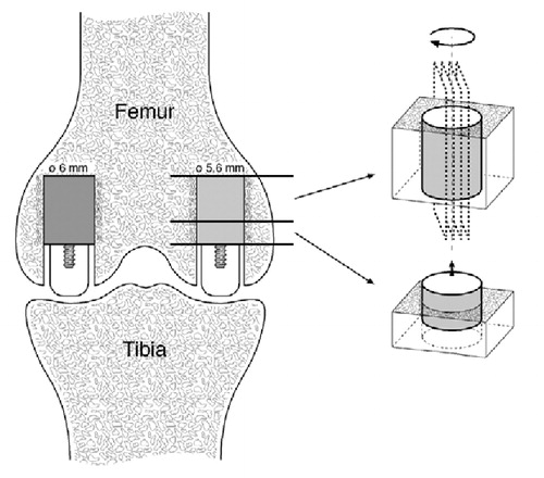 Figure 1. The weight-bearing implant model.The implants were inserted into cancellous bone of the distal femur.Ti implants (5.6 mm in diameter) were inserted medially and HA implants (6.0 mm in diameter) were inserted laterally.During weight-bearing, the load was transferred through the polyethylene plug from the tibial plateau to the test implant.Post-mortem, two sections were cut.The first section was used for push-out testing.The second section was used for histomorphometry as serially cut vertical sections were produced after initially random rotating the implant around its long axis.