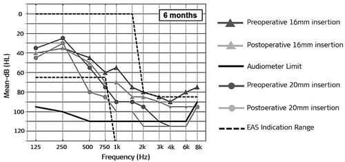 Figure 50. Air-conducted hearing thresholds at 6 months postactivation for 16 mm insertion (n = 3) and 20 mm insertion (n = 3) [Citation54]. Reproduced by permission of Wolters Kluwer Health, Inc.