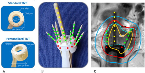 Figure 1. (A) Standard and personalized tandem-needle-template [TNT], with corresponding diameters and needle holes for parallel and oblique needles; (B) Personalized TNT fitted over the Varian tandem with both parallel and oblique needles in situ; (C) the tandem and personalized TNT with needles on MRI in coronal view showing oblique and parallel needle position (green dots), stopping positions in the tandem (yellow dots) and at ring level (red dots), CTVHR (blue dashed line) and isodose distribution (yellow 200%, red 90%, blue 50%).