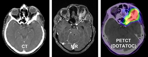 Figure 1. Imaging for target volume definition for proton radiotherapy of a skull base meningioma treated including CT, MRT and 68-Ga-Dotatoc.