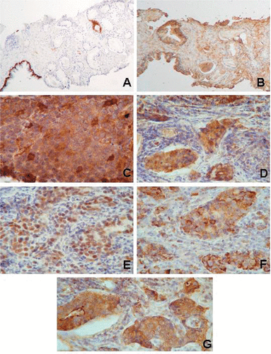Figure 2. Examples of the expression of HSP in prostate tissues. In a patient with an early tumour (PIN in a tru-cut biopsy), the cytokeratin 7 (A) shows the basal cells in the normal gland while in the PIN (right side) these cells are lacking and there is aberrant cytokeratin 7 expression in a tumour cell clone (note the brown positive immunoreaction, diaminobenzidine). In the serial section, HSPB1 appears in the stroma and with weak immunoreactivity in the normal gland but is absent in the PIN cells (B). In contrast, HSF1 and several HSP appear in the cancer tissue from a patient with advanced disease (metastasis in a cervical lymph node). This patient failed to respond to the GnRH agonist treatment and to suffered bone metastases. (C) note the variable expression of HSPB1 in cancer cells; (D) HSPA1A and HSPA8 (these two forms are recognised by the BRM22 monoclonal antibody) appear in the nuclei and cytoplasm in the tumour cell clusters; (E) HSF1 in the nuclei of the tumour cells; (F) HSPD1 in the cytoplasm of tumour cells; and (G) HSPA5. Original magnification ×30 (A, B), ×120 (C–G). The tissues were lightly counterstained with haematoxylin to reveal nuclei.