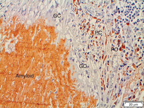 Figure 3. ‘Amyloidoma' immunolabeled with the immunoglobulin light chain lambda-specific monoclonal antibody pwlam (Citation73). Amyloid and a majority of plasma cells (PC) are strongly labeled. Note the giant cells (GC) between plasma cells and amyloid. The hypothesis is that plasma cells are synthesizing an amyloidogenic Ig light chain, which is modified by giant cells to amyloid fibrils.
