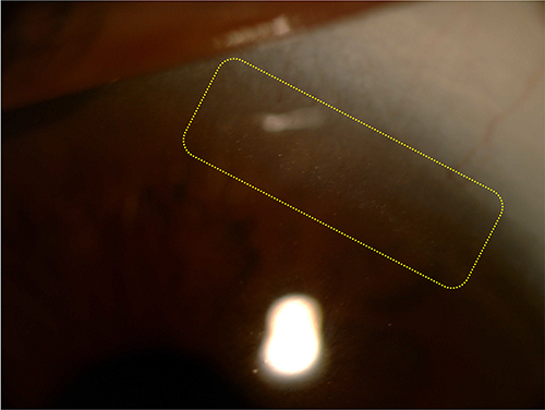 Figure 1 Corneal crystals. Slit- lamp biomicroscopy photo showing the crystalline deposits located at the limbus.