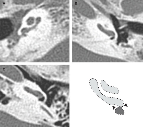 Figure 4. CT scan of region of the round window (RW) in our case. (A) Right ear, (B) left ear, and (C) control case. The RW in our case was remarkably small compared with the control case. The diameter of the RW is shown as arrowheads in the schematic representation.