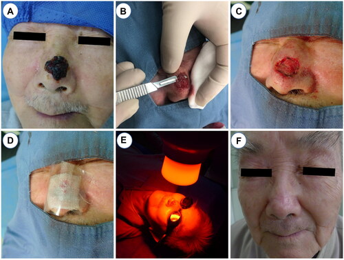 Figure 1. The procedures of S-PDT. (A) Routine disinfection towels and local lidocaine anesthesia. (B) Superficial shaving with a scalpel or razor. (C) Electrocoagulation was used to stop bleeding. (D)Apply pressure dressing with gauze, sterile gloves, cotton pads, or bandages. (E) Red light with wavelength of 633 nm and power of 80mW/cm2 was irradiated for 20 min. (F) Good postoperative recovery at 36 months follow-up.