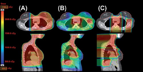 Figure 1. Comparison of the dose distribution of (A) three-dimensional conformal radiotherapy (3DCRT), (B) intensity-modulated radiotherapy (IMRT), and (C) proton therapy (PT) plans. The clinical target volume (CTV), breasts, heart, and liver are outlined in red, pink, green and yellow, respectively.