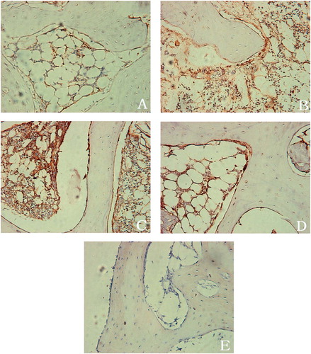Figure 1. Photomicrographs of subchondral bone immu-nostained with anti-BMP-2. A. Subchondral bone of the necrotic femoral heads untreated with shock waves: slight BMP-2 immunoreactivity (BMP-2-IR) was found in osteo-blasts and fibroblastic cells. B. 4 weeks after application of shock waves, the osteoblasts and the fibroblastic cells showed an increased level of BMP-2-IR. C. 8 weeks after shock wave application, BMP-2-IR was increased in the fibroblastic cells of the vascular granulation tissue invading the necrotic bone. Bone matrix also showed BMP-2-IR. D. 12 weeks after shock wave application, BMP-2-IR was observed in the trabecular bone and the marrow. Osteoblasts adjacent to the newly formed woven bone showed intensive expression of BMP-2. E. BMP-2-IR was absent when the primary antibody was replaced with PBS or non-immune mouse serum. (All images ×200).