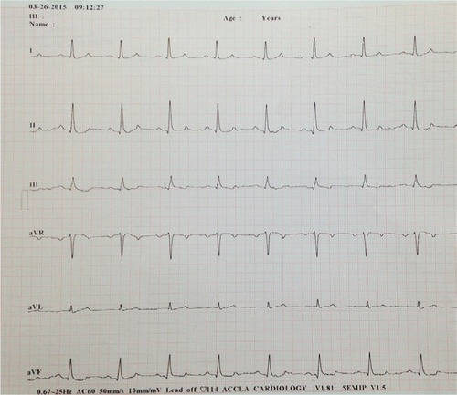 Figure 2 Electrocardiogram taken on the second day of hospitalization.