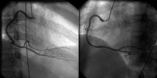 Fig. 2.  The coronary angiogram of the patient which was performed 1 week after her presentation showing normal right coronary artery.