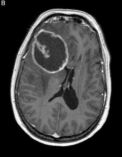 Figure B.  Eight months later, a large glioblastoma has developed.