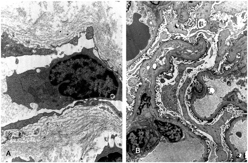 FIGURE 1. (A) Periglomerular capillary showing 3–4 layers of lamina densa in the basement membrane (EM original 10000x). (B) Same sample of A. Detail of a glomerulus with no relevant abnormalities (EM, original 1500x).