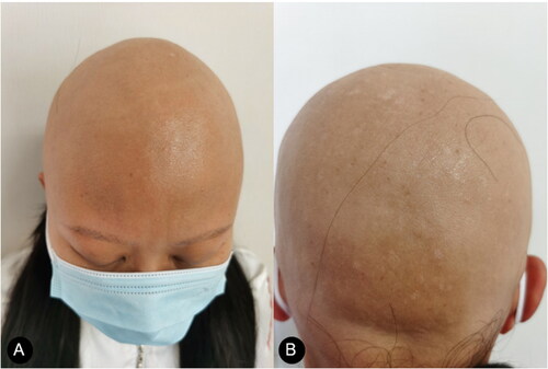 Figure 1. (A, B). Total loss of all the scalp hairs and Partial loss of eyebrows and eyelashes.