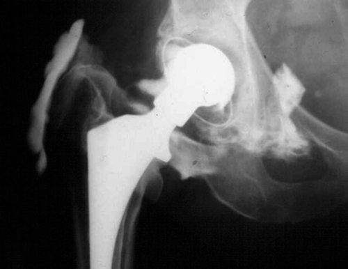 An arthrogram showing leakage of the contrast medium from the pseudojoint cavity to a bursa developed in the trochanter area after total hip arthroplasty, which had been performed using the anterolateral approach. This finding is diagnostic of an avulsion of the abductor muscles from the medial aspect of the greater trochanter.