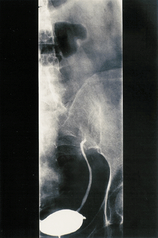 Figure 1. Left retrograde pyelogram showed the complete retrograde obstruction of ureter over sacro-iliac joint level.