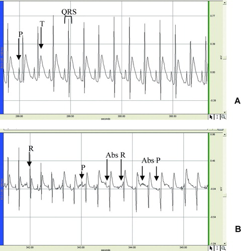 Figure 3.  Effects of the n-butanol extract of the leaves of Kalanchoe crenata on the electrocardiogram of anesthetized rat. (A) control, (B) electrocardiogram recorded 30 seconds after extract (10 mg/kg) administration showing the progressive disappearance of P and R waves as well as the reduction of heart frequency. Abs R = absence of R wave; Abs P = absence of P wave.