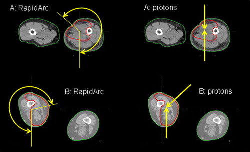 Figure 1. Arc and beam arrangement for two typical cases (A and B): RapidArc on the left, proton plans on the right.