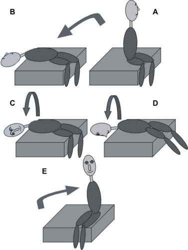 Figure 3 The Epley canalith repositioning procedure when the posterior semicircular canal of the left ear is affected.