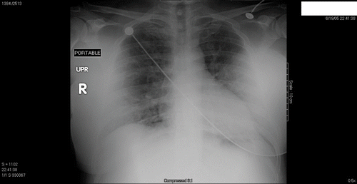 Fig. 1.  Initial chest radiograph from patient 1 shortly after presentation.