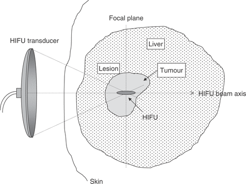 Figure 1. Diagrammatic illustration of the principle of HIFU. High-intensity ultrasound waves are generated by a transducer outside the body and focussed onto a small region deep within tissue. HIFU-induced heating causes cell death by thermal necrosis within the focal volume, but leaves tissue elsewhere in the propagation path unaffected.