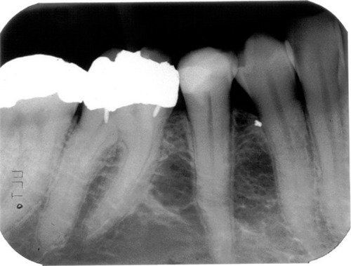 Figure 2 The radiograph is of a 48-year-old osteoporotic female. The trabecular network is disrupted in two locations around the second premolar.
