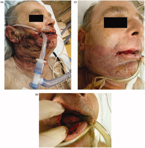 Figure 1. (a) Sodium hydroxide (caustic soda; Destop®) ingestion. Additional skin exposure on face, neck, and right arm. 4-½ hours post-ingestion. (b and c) 8 d post-ingestion. The facial and oral lesions are completely healed.