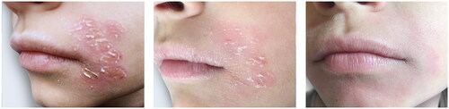 Figure 6. This chronic perioral dermatitis in this young boy was finally controlled by the treatment.