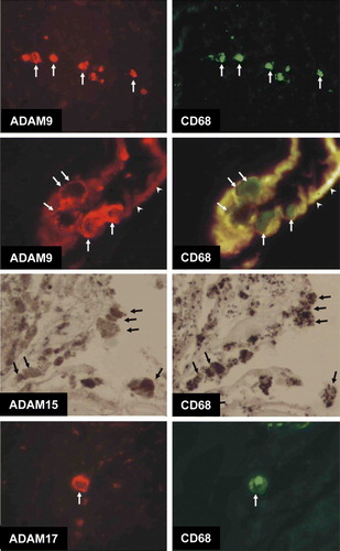 Figure 5.  Double immunofluorescence images demonstrating co-localization of ADAM-9 and ADAM-17 and CD68, and mirror image sections showing the co-localization of ADAM-15 and CD68. ADAM-9-immunoreactive cells at the border of adventitia and media (arrows) are also labeled with CD68. High-magnification image showing ADAM-9/CD68-immunoreactive cells (arrows) adhered to the intima of neovascularization capillary (arrowheads point to the intima exhibiting red/yellow autofluorescence). ADAM-9 labeling is very strong in the cell membrane. Mirror image sections indicating co-localization of ADAM-15 and CD68. Arrows point to the cells immunoreactive to both antigens. Double immunofluorescence photographs demonstrating the co-localization of ADAM-17 and CD68. ADAM-17 immunoreactivity is very strong in the cell membrane whereas CD68 labeling is seen throughout the cytoplasm.