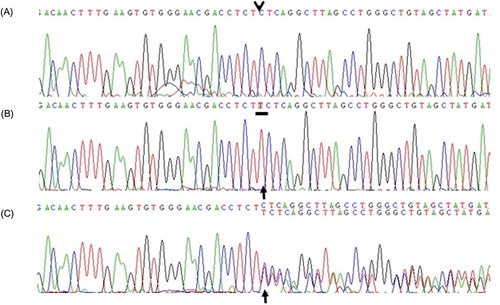 Figure 3. Nucleotide sequencing of the GLA gene by using genomic DNA. (A) Control. (B) Patient DNA sequence reveals a homozygous small insertion mutation, that is, c.1030_1031insT (p.Leu344fsX31). (C) Patient’s mother DNA sequence shows that the mother is a heterozygous carrier for c.1030_1031insT (p.Leu344fsX31).
