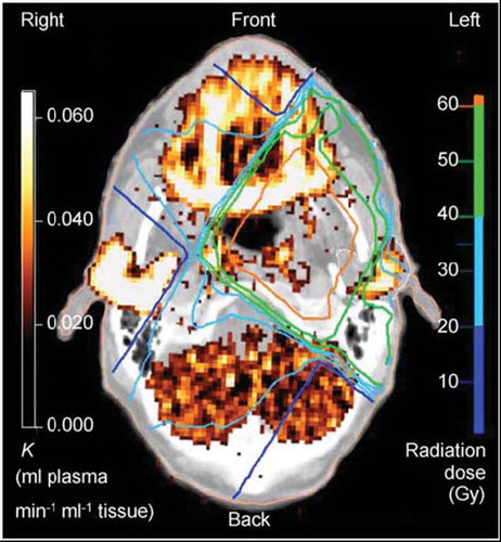 Figure 5. Transaxial co-registered image of the CT dose-plan and functional PET through the parotid glands. The CT dose-plan shows the radiation isodose curves (right-hand colour scale). The functional PET image gives voxel values of the net metabolic clearance of 11C-methionine (left-hand colour scale). From Buus et al. [Citation76].