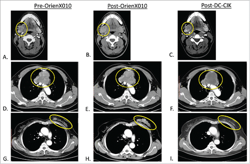 Figure 2. (A) Metastatic melanoma baseline CT of right submandibular (SM) met pre-OrienX010, (B) SM met post-OrienX010, and (C) SM met s/p after three cycles of DC -CIK therapy. (D) Malignant thymoma baseline CT of mediastinal mass (MM) pre-OrienX010, (E) MM after OrienX010, and (F) MM after two cycles of DC -CIK therapy. (G) Metastatic breast cancer baseline CT of left breast (LB) mass before OrienX010, (H) LB mass after OrienX010, and (I) LB mass after one cycle of DC -CIK therapy.