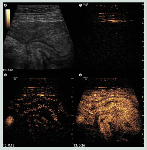 Figure 6. Contrast-enhanced ultrasonography of the gastrointestinal wall.(A) B-mode image of the terminal ileum where a diseased bowel loop has fused causing a sharp turn and an obstruction. (B) The corresponding image in contrast mode at the time of injection showing only interface echoes in the abdominal wall. (C) Just after the arrival of contrast in the right iliac artery and the bowel submucosa. (D) The contrast enhancement has reached maximum intensity. It is not only brighter in the submucosa but also filling the mucosa and proper muscle.Image courtesy of K Nylund.